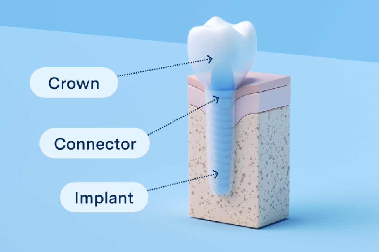 Diagram showing the structure of a front tooth dental implant with labeled parts including the crown, connector, and implant base, designed for Aspen Dental.