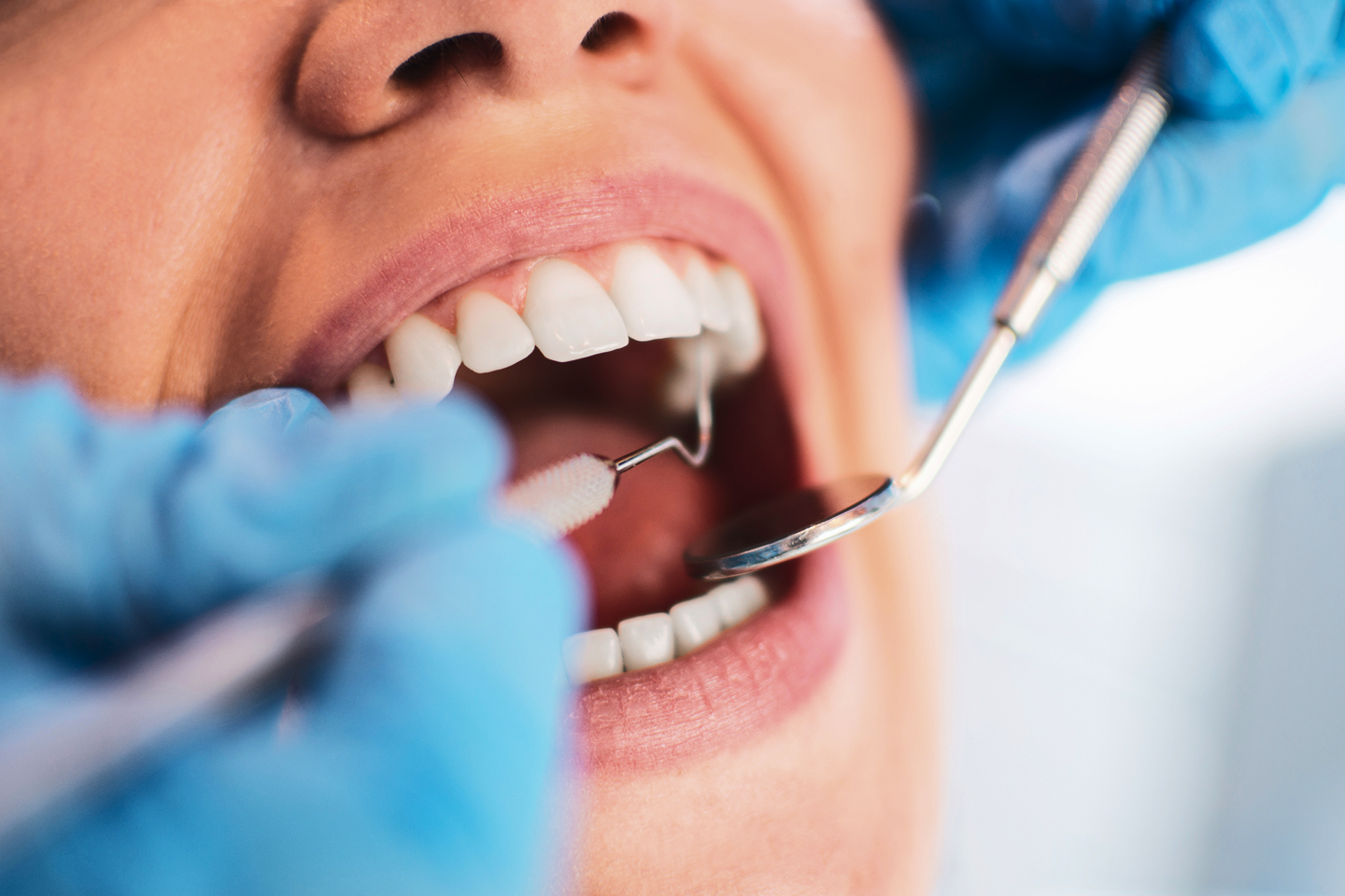 A close-up of a patient’s mouth during a dental examination, with a dentist using a probe and mirror to check for gum disease. The patient's gums and teeth are carefully inspected for signs of plaque buildup and periodontal issues. Aspen Dental provides expert diagnostics and treatment for gum health.