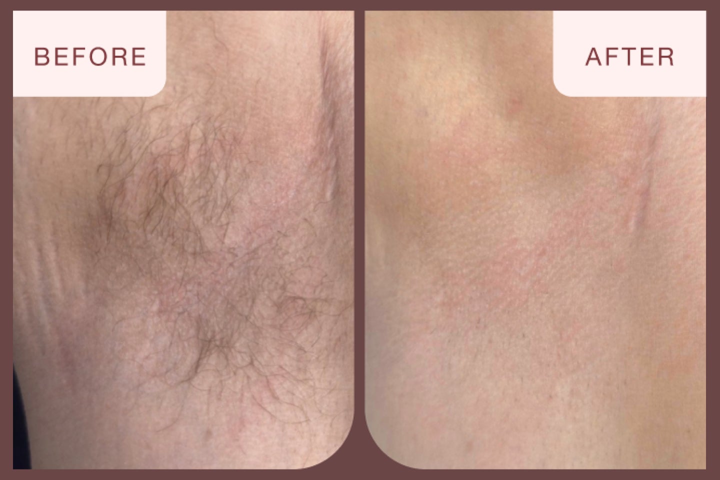 Before and after closeup of the arm pit area after a laser hair removal treatment at Chapter Aesthetic Studio.