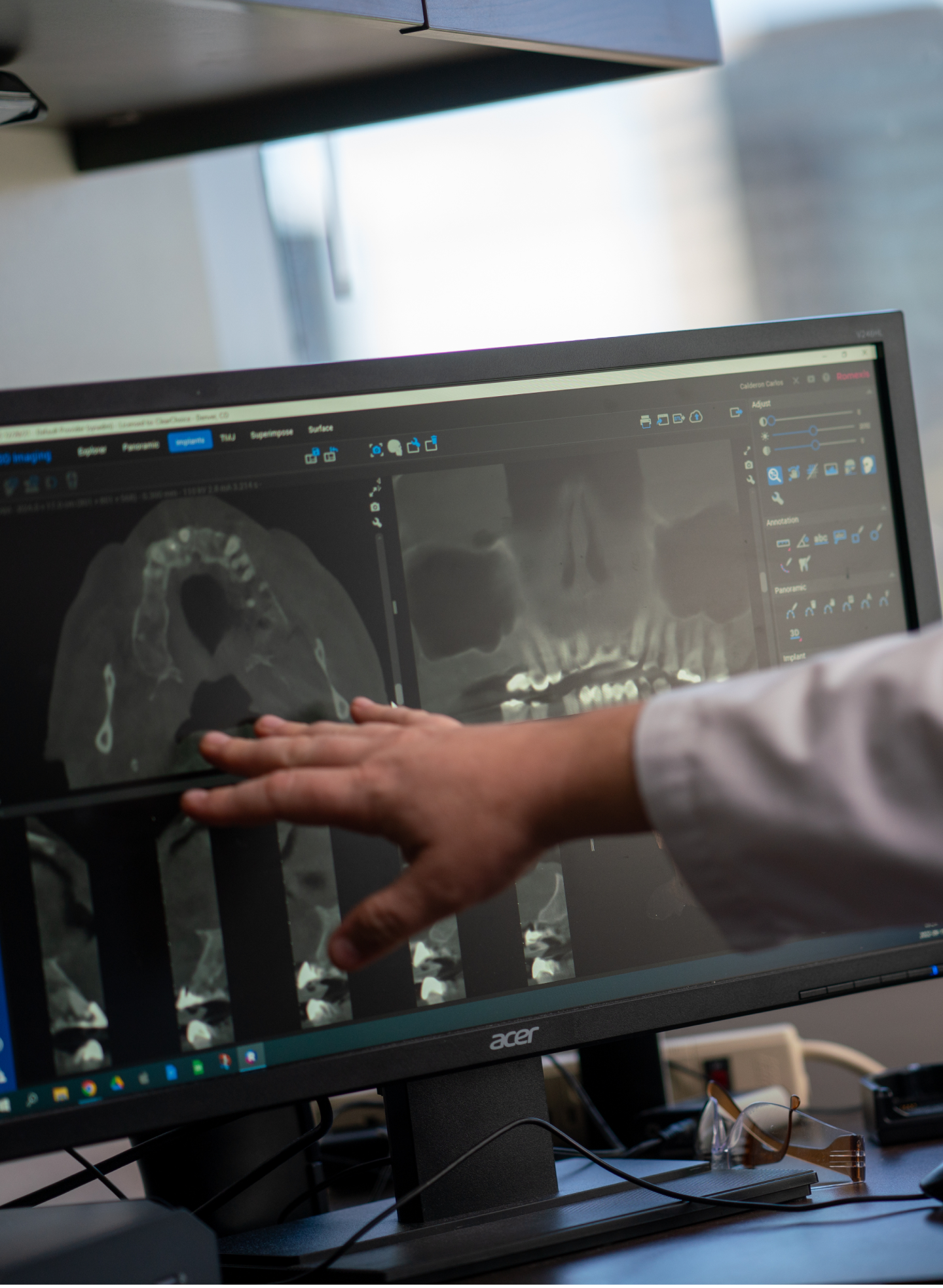  Dental professional pointing at a computer screen displaying a digital X-ray of molars, illustrating the process of evaluating molar implants at ClearChoice.