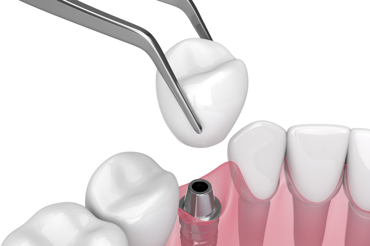 3D rendering of a front tooth implant procedure showing a dental crown being placed onto an abutment, highlighting advanced implant techniques at Aspen Dental.