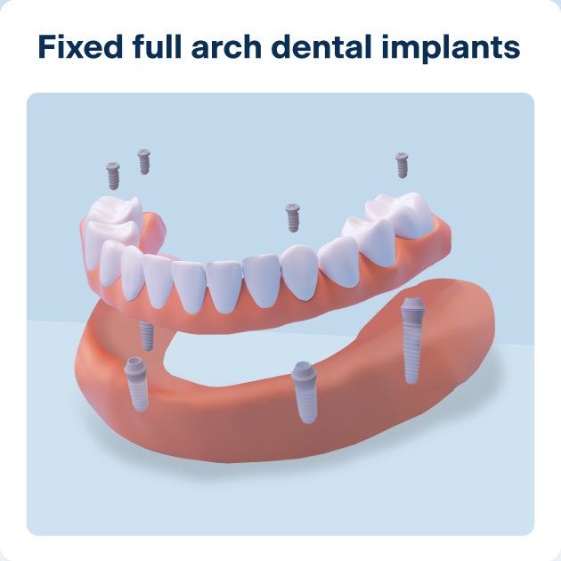 3D illustration of fixed full arch dental implants showing a full set of upper teeth anchored by implants; explains what dental implants are and how they provide full-mouth restoration.