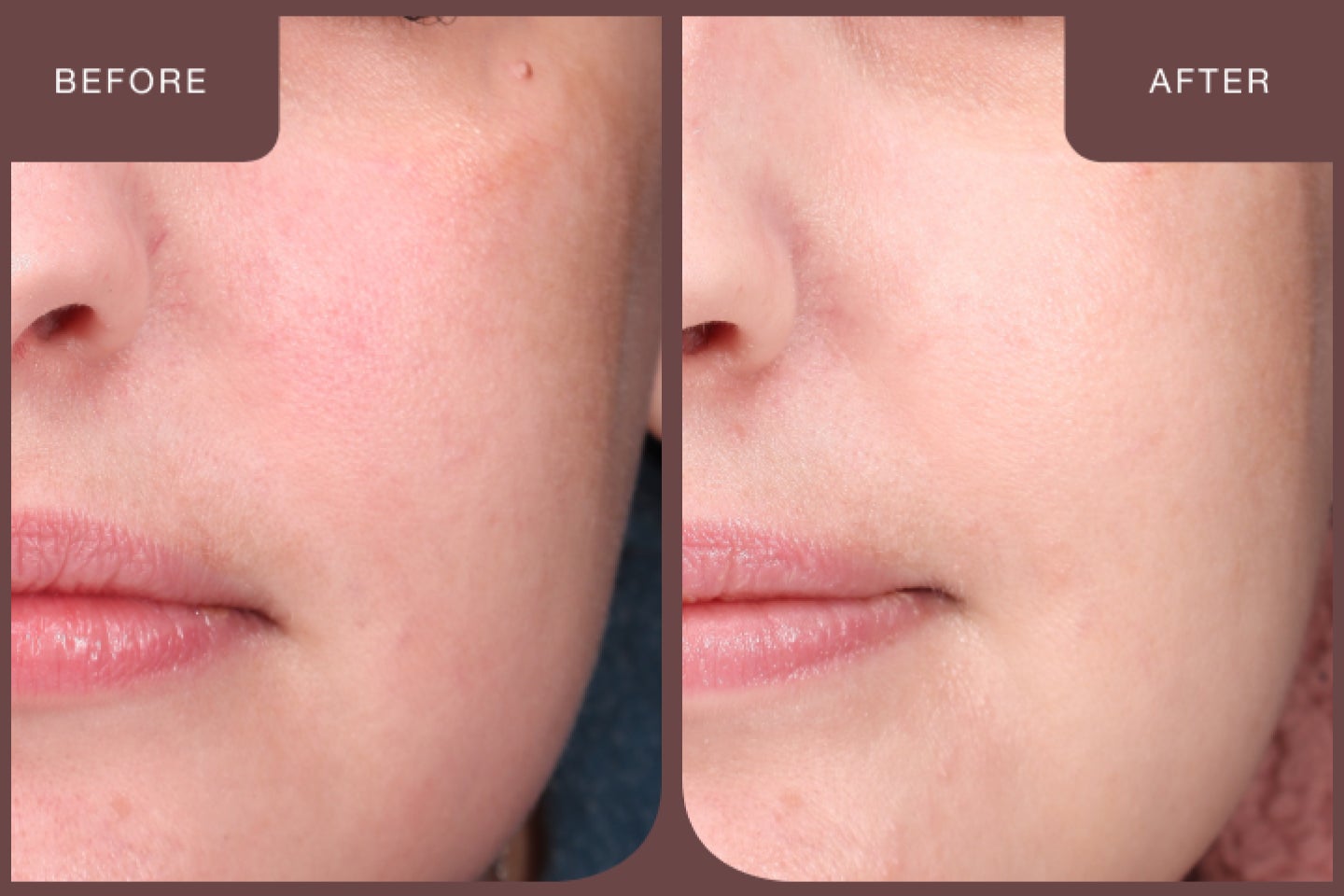 Before and after image of a closeup of a guest's face after a laser facial treatment.