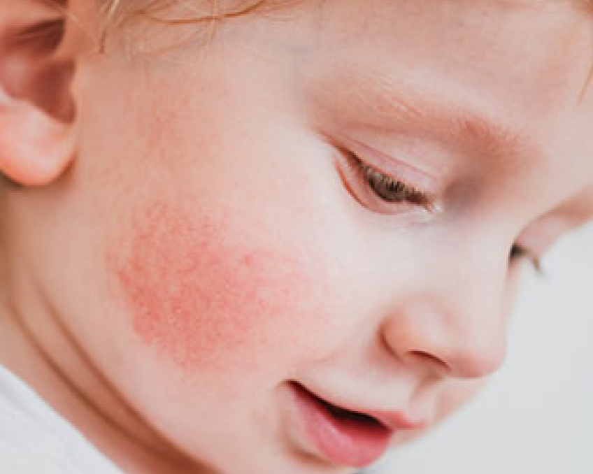 A boy with flushed cheeks