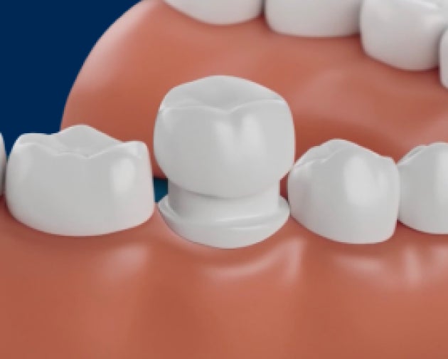A 3D illustration of a tooth cap placed on a dental model, highlighting the precise restorative techniques for tooth caps at Aspen Dental.