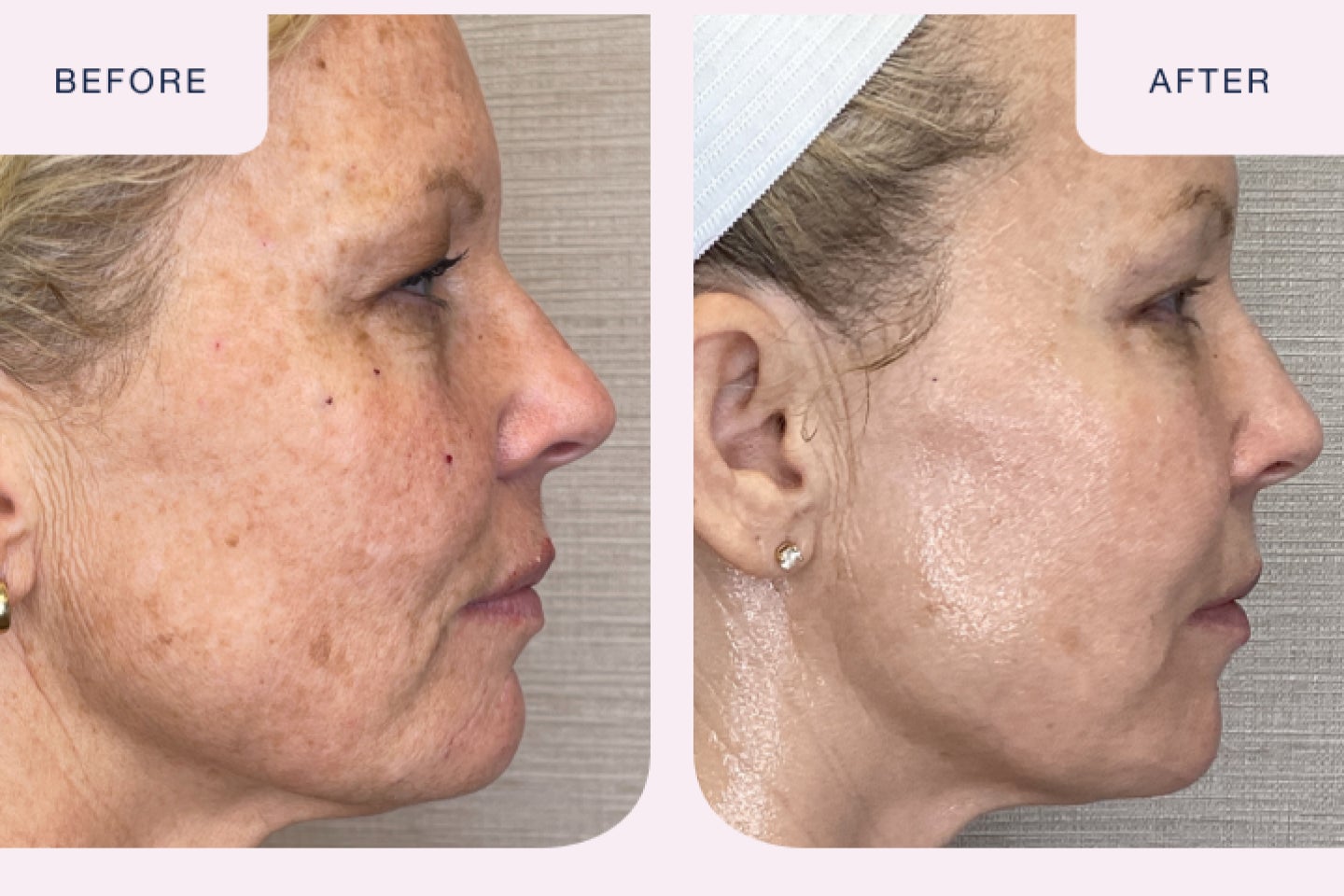 Before and after image of a coolpeel treatment.