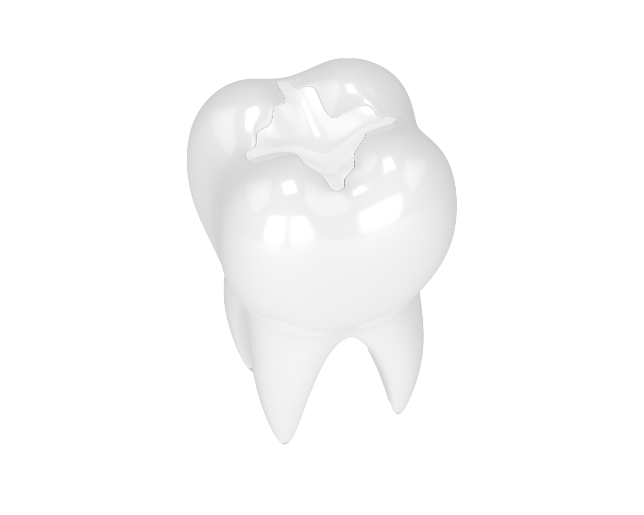 A 3D model of a tooth featuring a resin composite filling, highlighting a modern and aesthetic dental restoration procedure by Aspen Dental.