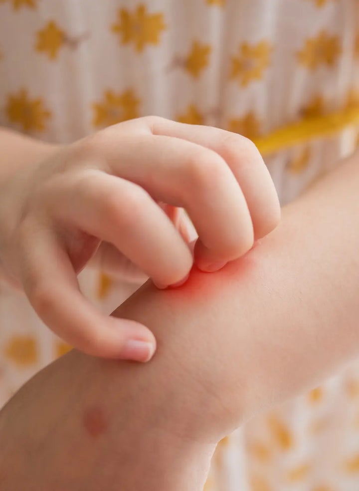 A child is scratching hives on their arm with their hand.
