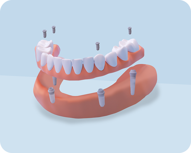 3D illustration of a full-mouth dental implant solution with multiple implants and a full arch of teeth offered by ClearChoice.