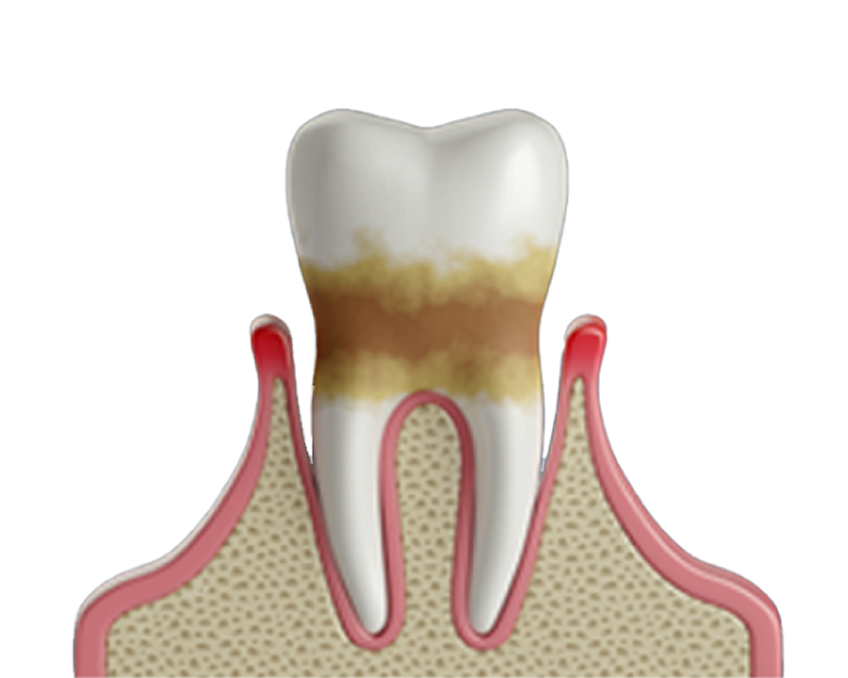 3D illustration of a tooth with severe plaque and tartar buildup, leading to inflamed and receding gums, a sign of advanced gum disease. The progression of periodontitis is evident, highlighting the need for professional dental care. Aspen Dental provides expert treatment options to restore gum health.