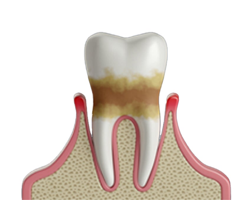 3D illustration of a tooth with severe plaque and tartar buildup, leading to inflamed and receding gums, a sign of advanced gum disease. The progression of periodontitis is evident, highlighting the need for professional dental care. Aspen Dental provides expert treatment options to restore gum health.