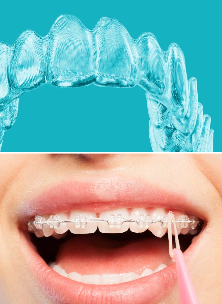 Close-up of a set of Motto clear aligners on a blue background, along with an image showing aligners being placed on teeth.