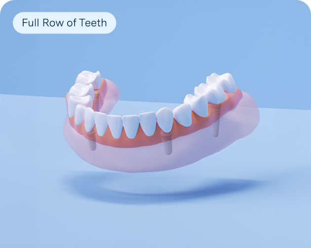 A 3D rendering of fixed full arch implants showing a complete set of teeth, demonstrating Aspen Dental's full mouth restoration solutions.