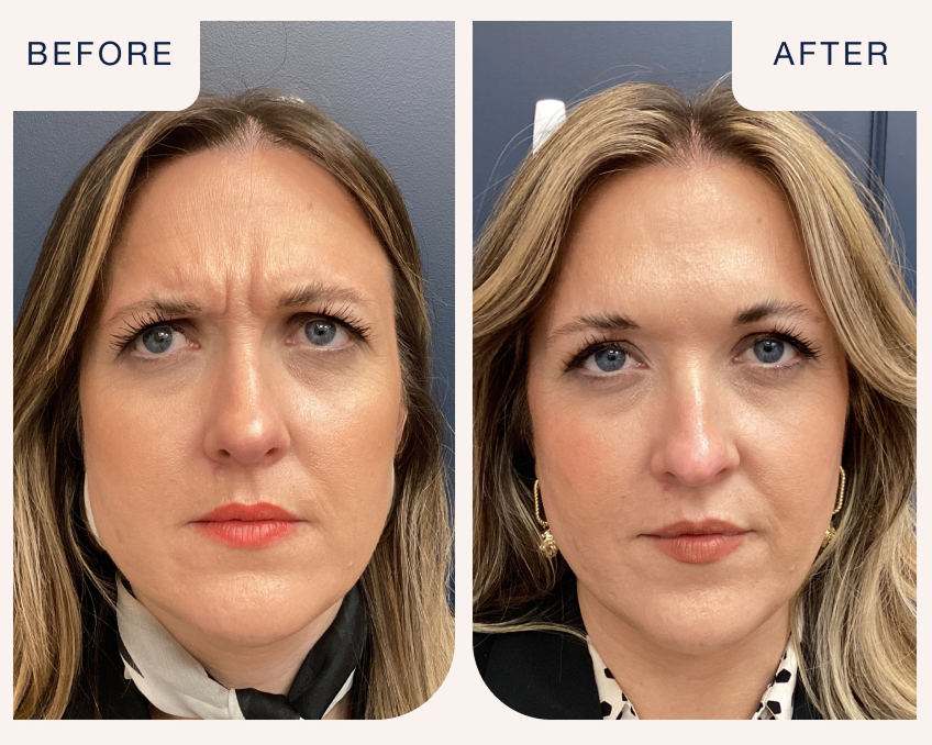 Botox before and after comparison of a woman’s forehead frown lines, showcasing Chapter’s treatment results. Text on image reads “Before and After.”4o