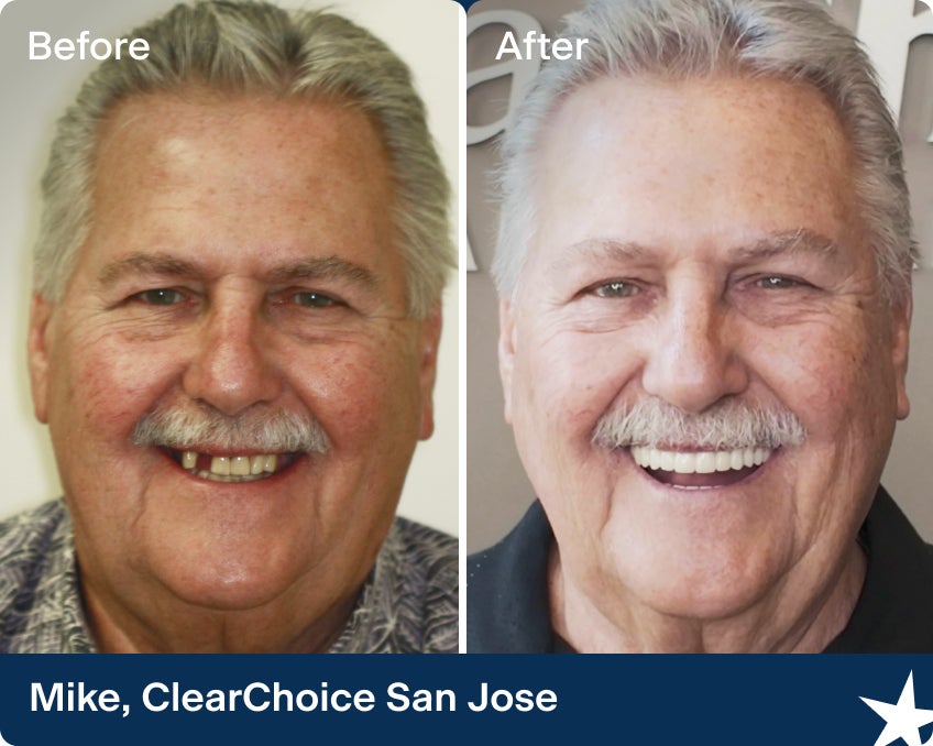A before and after photo of Mike, a ClearChoice patient from the San Jose center, smiling into the camera with his brand new zirconia dental implants.