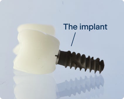 An image of a tooth with an implant connected by the abutment. The implant acts as the anchor for the tooth to be attached to the jaw.