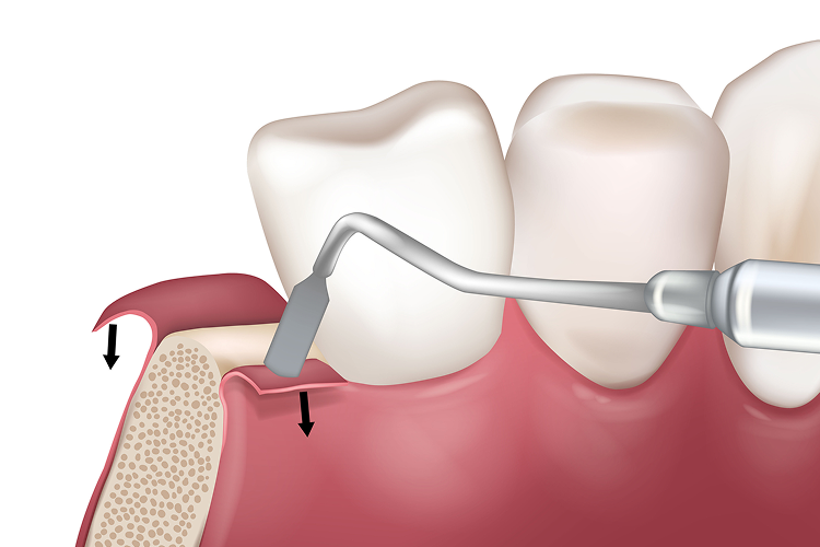 3D illustration of a dental procedure involving gum tissue adjustment, where a tool is used to reshape or reposition the gumline. This treatment helps address gum recession and improve periodontal health. Aspen Dental offers expert solutions for gum restoration and disease prevention.