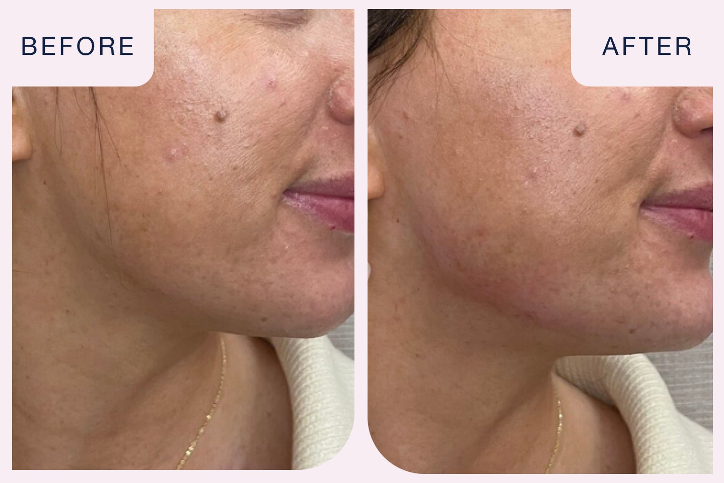 Before and after image of a filler treatment targeting the jawline.