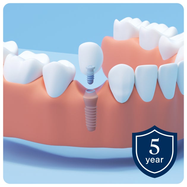 Illustration of a single tooth Implant being inserted into the lower jaw, showing the gum, surrounding teeth, and the implant screw with a crown positioned above it. A shield icon on the bottom right corner has text that reads "5 year" indicating the warry on implants.