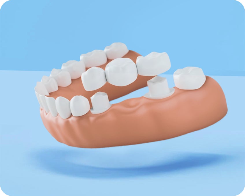 Traditional bridge model displaying a set of connected crowns supported by adjacent teeth, used as an alternative to dentures.