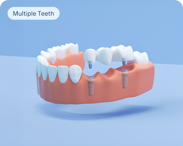 3D rendering of an implant-supported bridge replacing multiple teeth in the upper jaw, offered by Aspen Dental.
