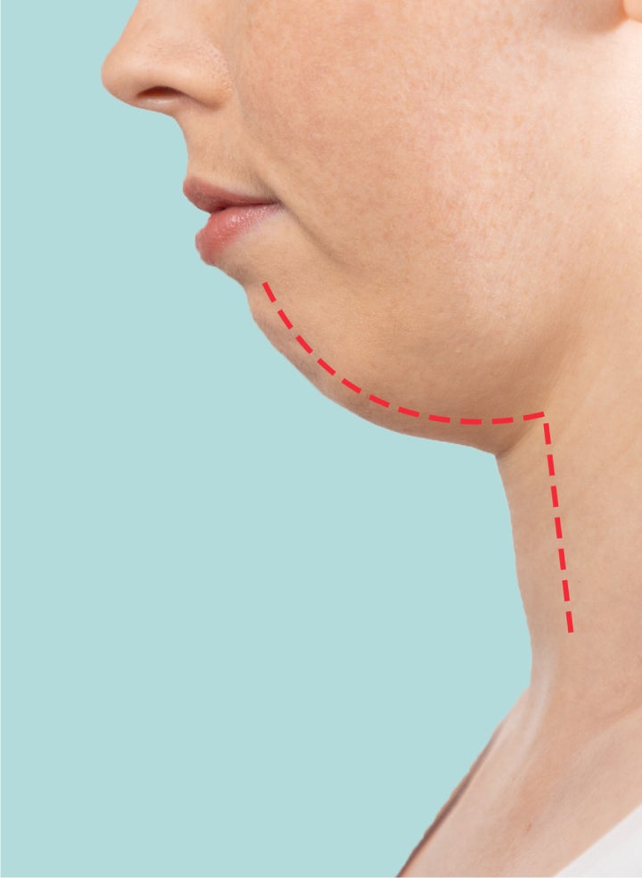 Can invisible aligners fix an overbite?