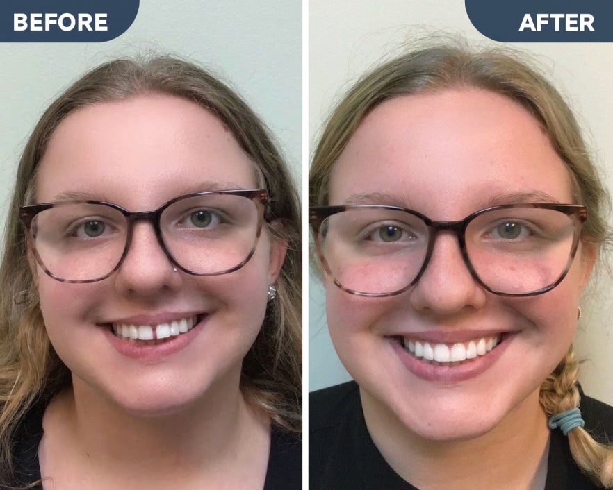 Before and after photos of a smiling woman wearing glasses, showing the results of Motto clear aligners treatment.