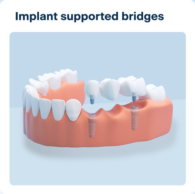 3D render of implant-supported bridges with multiple teeth replaced over two implants; demonstrates what dental implants are and their function in spanning gaps between natural teeth.