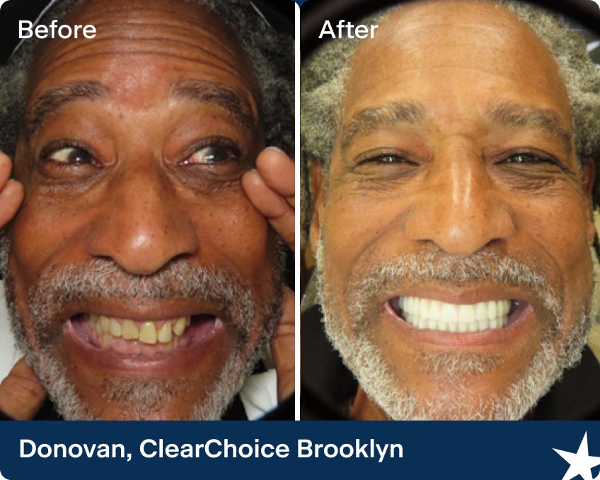 Before and after photos of Donovan smiling widely, showcasing restored teeth; illustrates what dental implants are and their effect on full smile transformation.