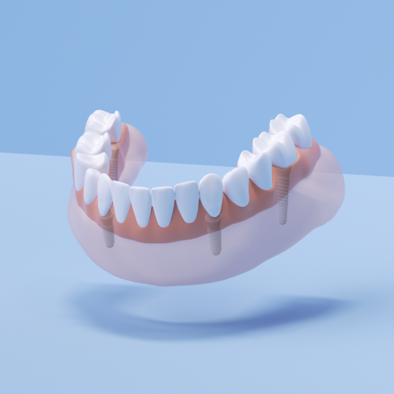 Aspen Dental fixed full arch implant model for the lower jaw, showcasing a seamless set of teeth anchored by multiple implants for stability and durability.