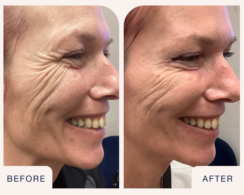 Side-by-side before and after images of a woman smiling, showing reduced crow’s feet and smoother eye area after Xeomin treatment at Chapter Aesthetic Studio.