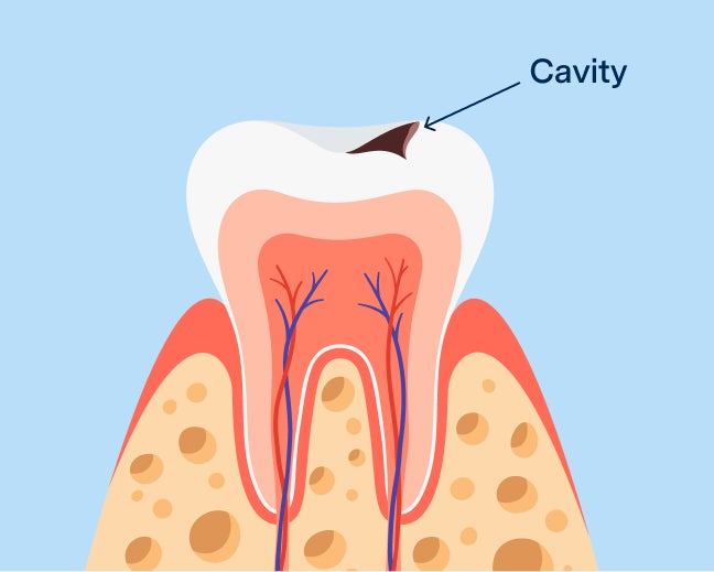 Cross-sectional diagram of a tooth showing the progression of a cavity, with labeled damage to the enamel and pulp, used by Aspen Dental to explain cavities and tooth decay.