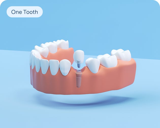 A 3D rendering of a single tooth implant replacing one tooth in the lower jaw, highlighting Aspen Dental's single tooth replacement option.