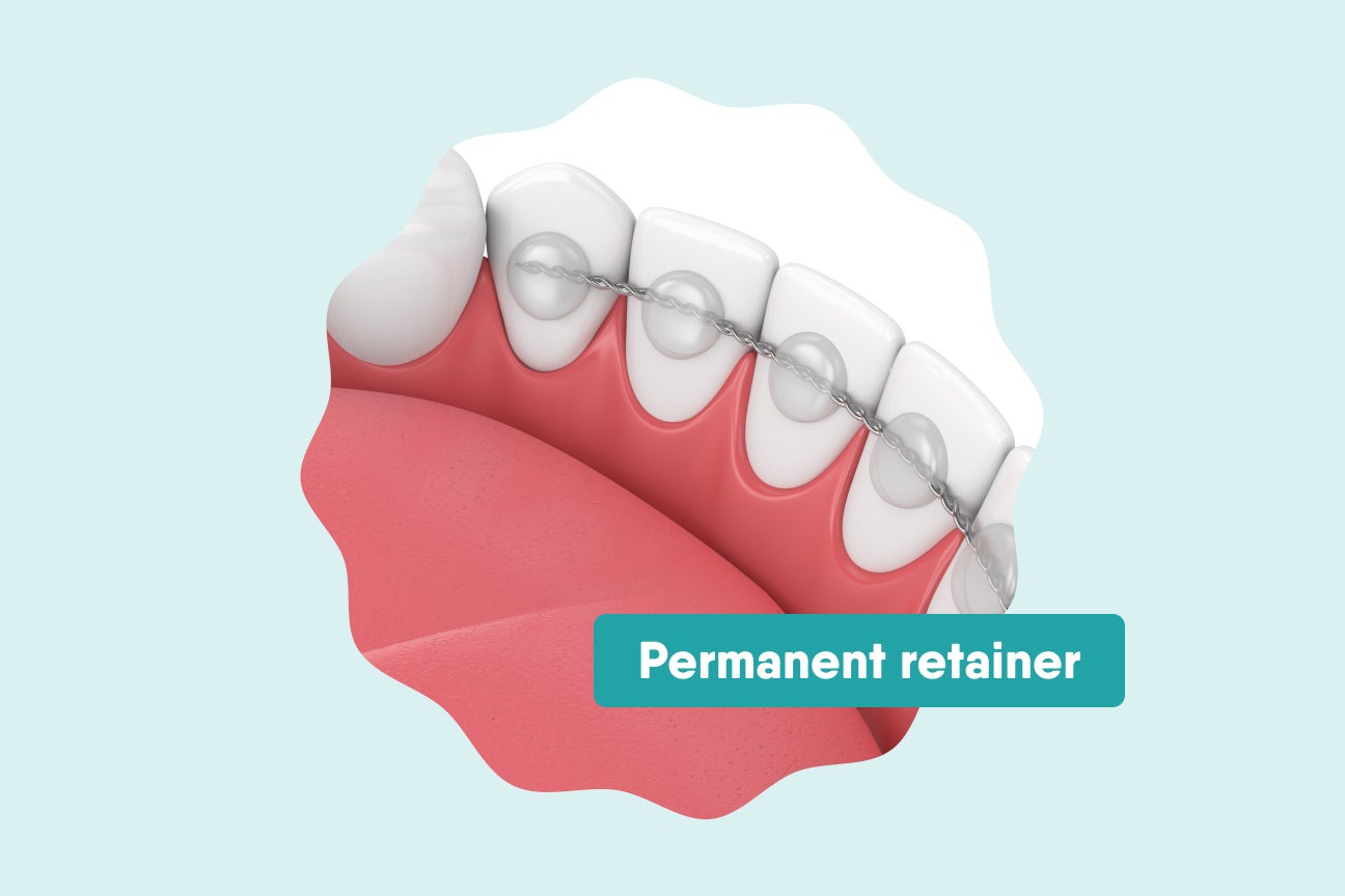 Illustration of teeth with Motto permanent retainer wire fixed to the back of the lower front teeth for alignment support.