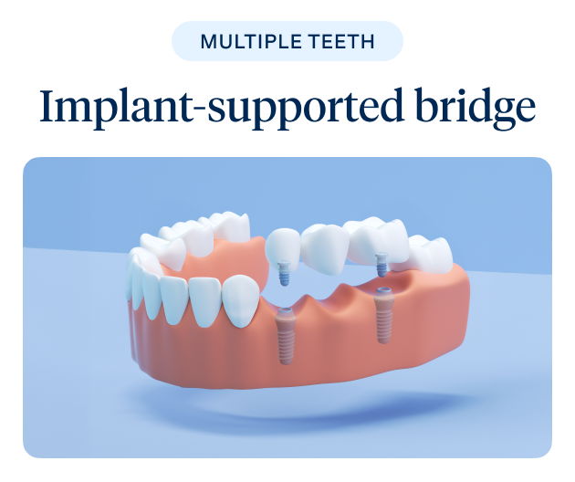 A 3D illustration of an implant-supported bridge showcasing multiple teeth restoration, a service offered by Aspen Dental.