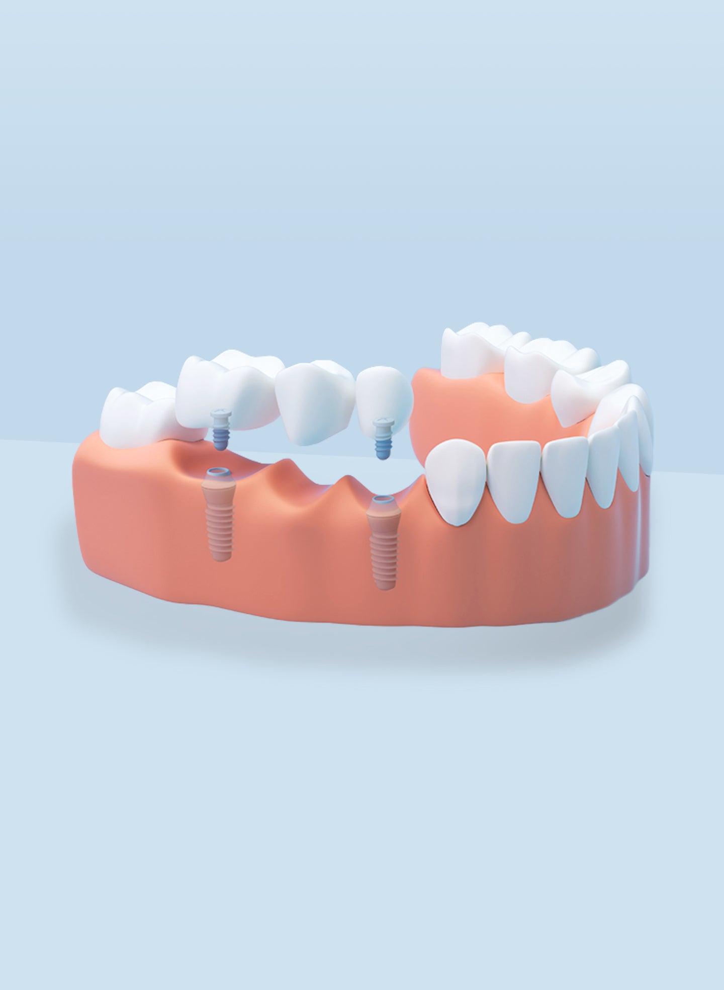 A 3D dental model showing a row of teeth supported by three visible implants embedded in a pink gum base. The visual explains the structure and design of an implant-supported bridge.