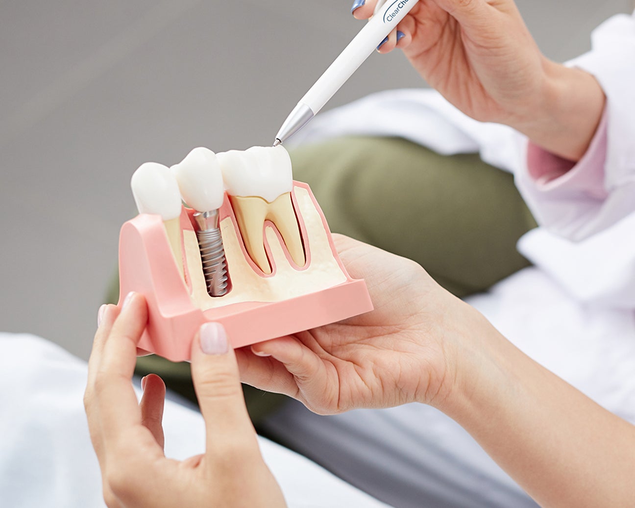 A dentist explaining a titanium dental implant using a detailed model, showcasing the structure and placement of the implant.