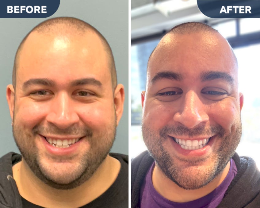  Before and after photos of a smiling man showing the results of Motto clear aligners treatment.