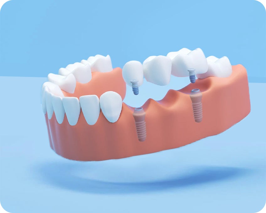 Full fixed arch implants model showing a complete row of teeth attached to four implants, offering a stable alternative to dentures.