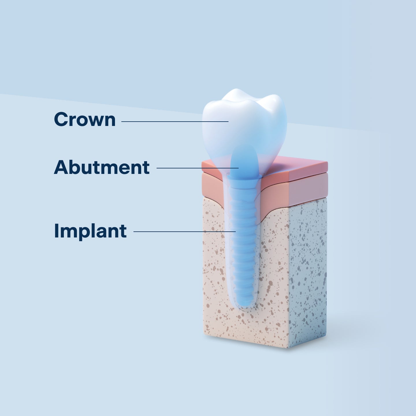 A 3D diagram of a dental implant showing the three main parts: the crown, abutment, and implant. The illustration depicts how a dental implant is structured within the gum and bone.
