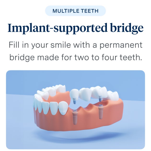 Implant-supported bridge - Fill in your smile with a permanent bridge made for two to four teeth. 