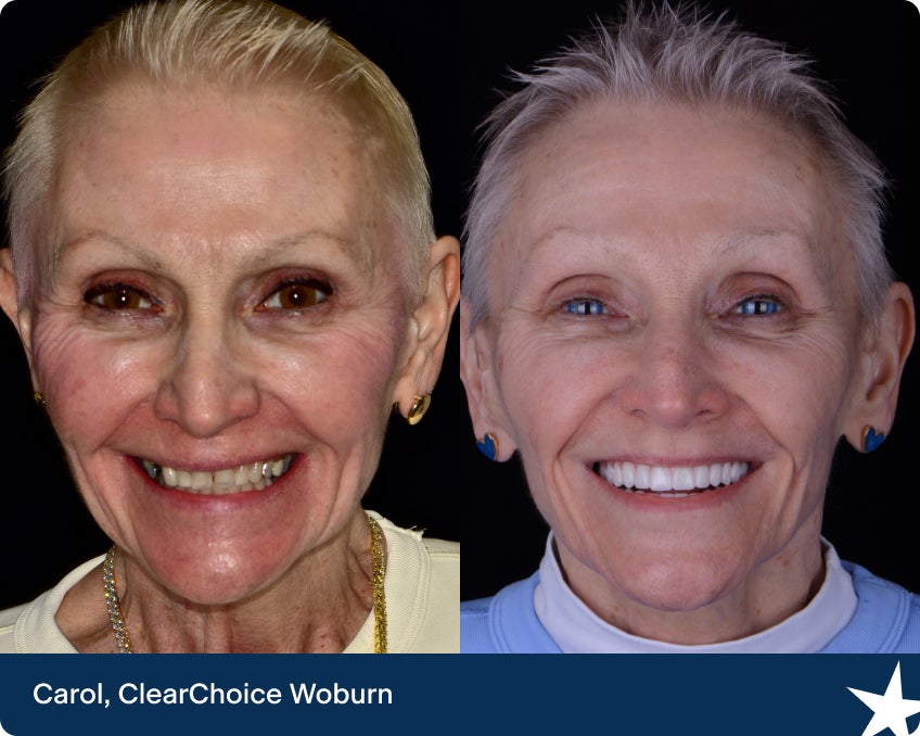 Before and after photos of Carol, a patient at ClearChoice Woburn, showing her smile transformation with dental implants.