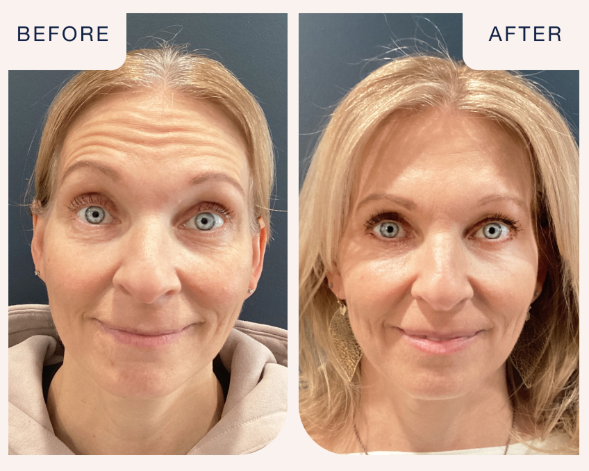  Botox before and after comparison of a woman’s forehead wrinkles, highlighting treatment results at Chapter. Text on image reads “Before and After.”4o