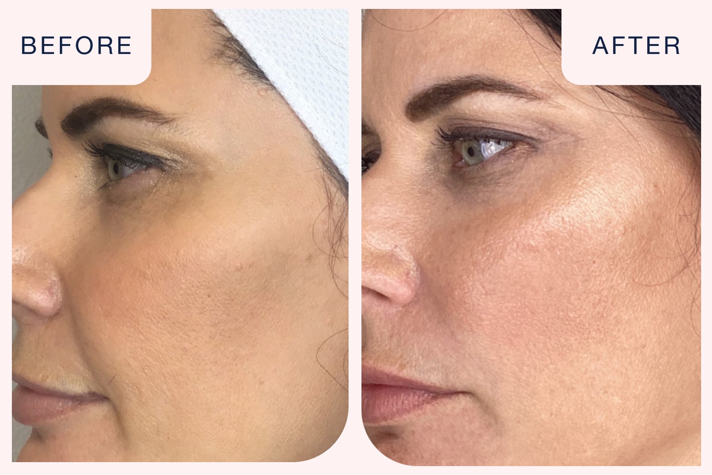 Before and after image of a filler treatment targeting cheeks.