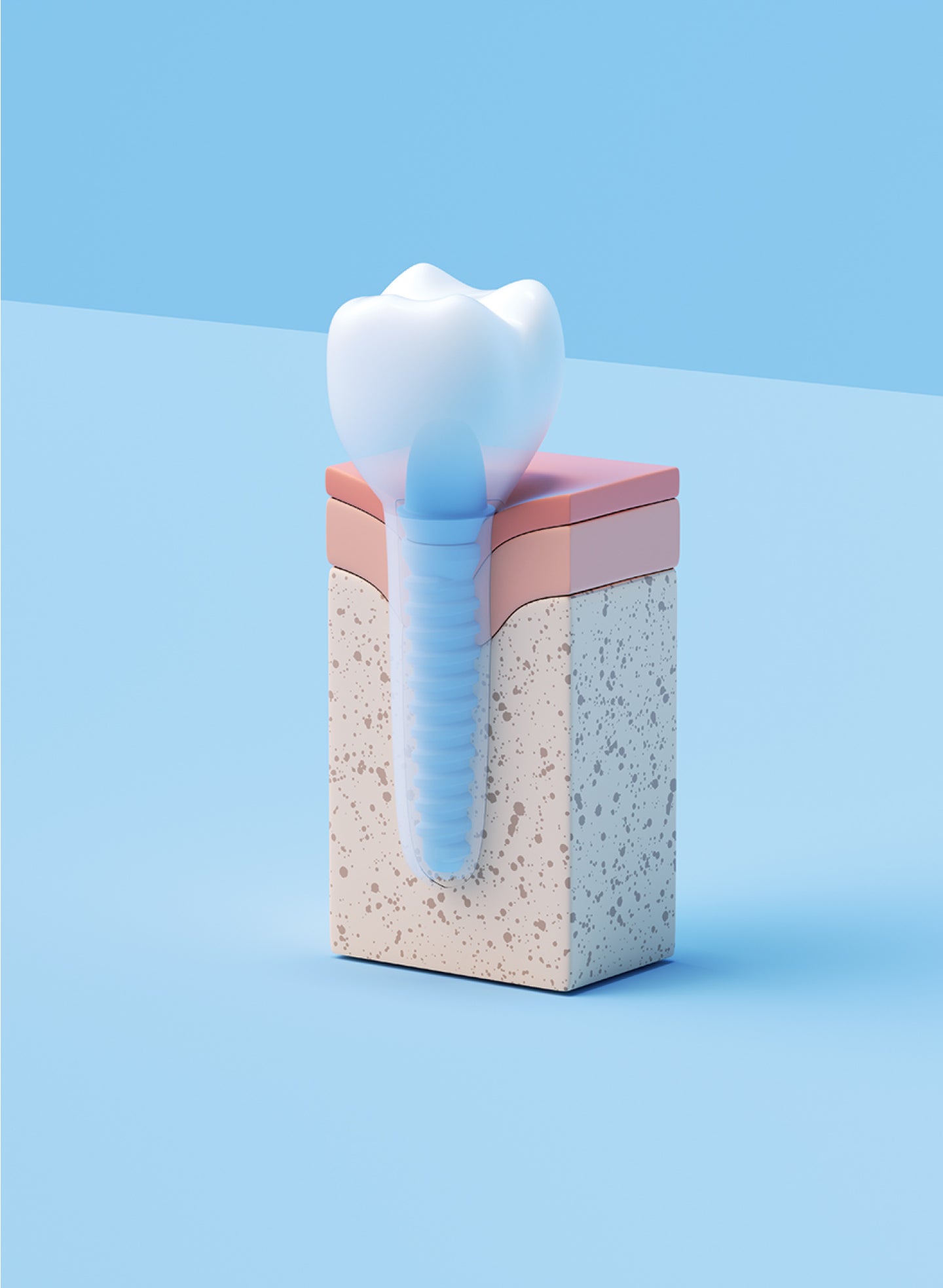 3D illustration of a dental implant model, consisting of a screw and a crown, displayed on top of a gum and bone structure, against a light blue background.