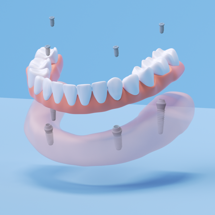 Aspen Dental All on 4 dental implants. 