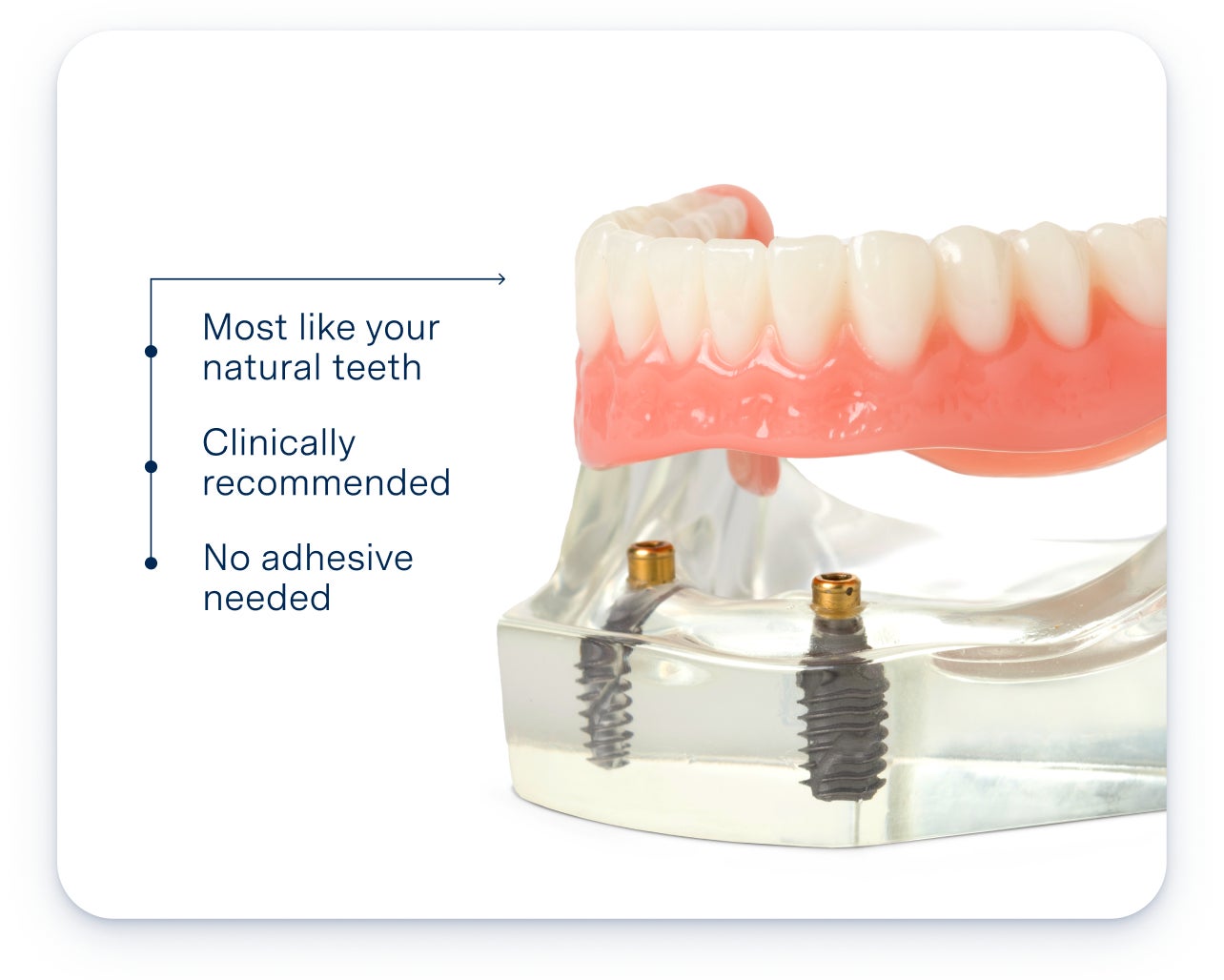 A close-up of a dental implant model showing a realistic set of teeth secured by implants, with benefits like natural feel, clinical recommendation, and no adhesive needed. The image highlights the effectiveness of dental implants for tooth replacement.