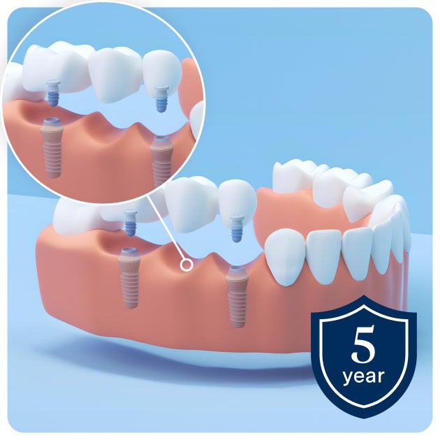 Illustration showing dental implants bridge on lower jaw set against a blue background. An inset image highlights the lower jaw's implant supported bridge. A shield icon on the bottom right reads "5 year" indicating the warranty.