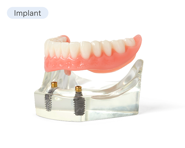 A model of implant-supported dentures showcasing stability and a secure fit without adhesives. The image emphasizes the benefits of implant dentures for long-term tooth replacement.