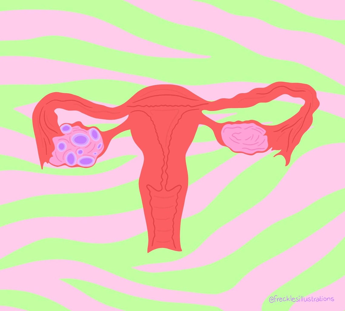 PCOS graphic